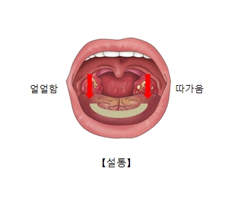 설염, 중년 여성多…그 이유는?